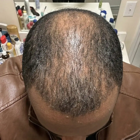 Hair before using Medíté