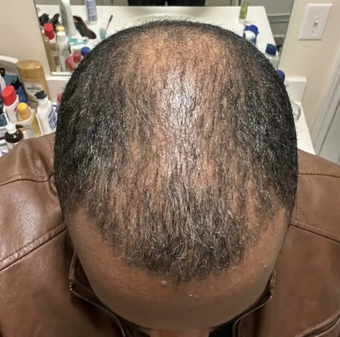 Hair before using Medíté