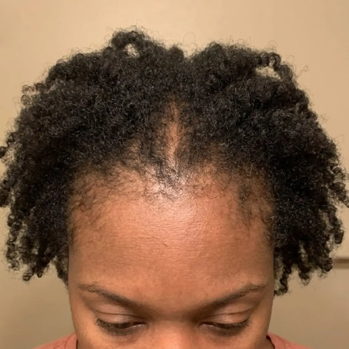 Before photo of a woman with visible hair thinning, a widening part line, and reduced hair density before beginning a hair growth routine designed to support fuller, healthier-looking hair.