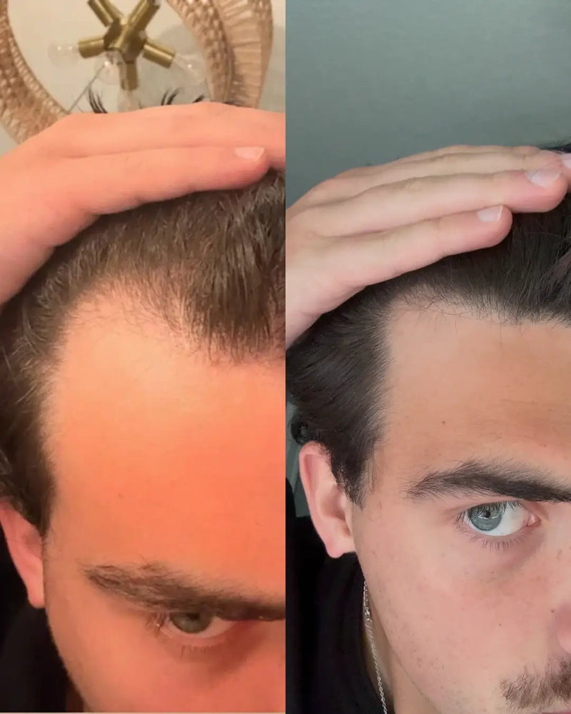 A side-by-side before and after comparison of a man's hairline and thinning hair treatment. The left side shows visible hair loss at the crown, while the right side shows fuller, denser hair.