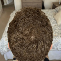After photo showing visible hair regrowth, fuller hairline, and stronger strands after using Medité rosemary hair growth oil