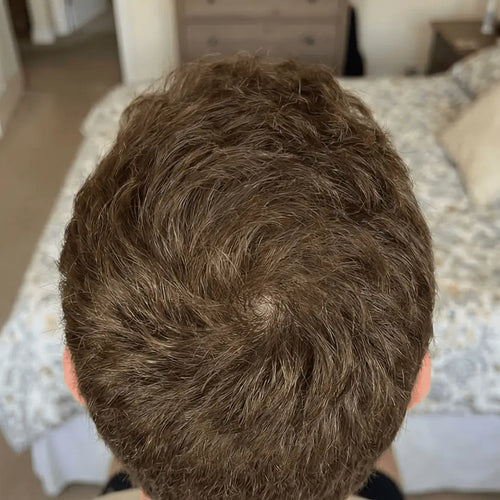 After photo showing visible hair regrowth, fuller hairline, and stronger strands after using Medité rosemary hair growth oil