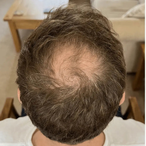 Before photo of a man with hair loss and a receding hairline before starting Medité rosemary hair growth oil