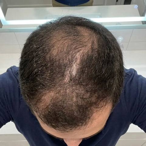 Hair before using Medíté