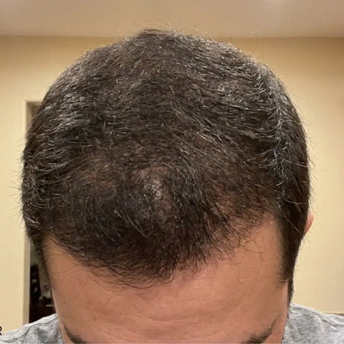 After photo of a man showing thicker-looking hair, improved hair density, a fuller hairline, and visible hair growth results following a consistent hair regrowth routine.