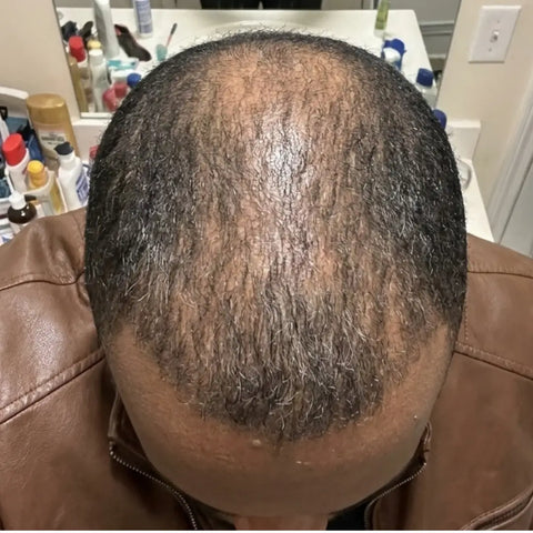 Hair before using Medíté