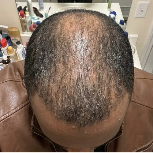Before photo of a man with a receding hairline, thinning hair, and reduced scalp coverage before starting a hair regrowth treatment and hair growth routine.