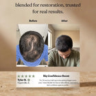 Medite hair growth oil before and after verified results showing Invictus by Medite regrowing a male crown naturally