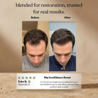 Men's hair regrowth before and after using Invictus rosemary oil, thicker fuller hair after 90 days