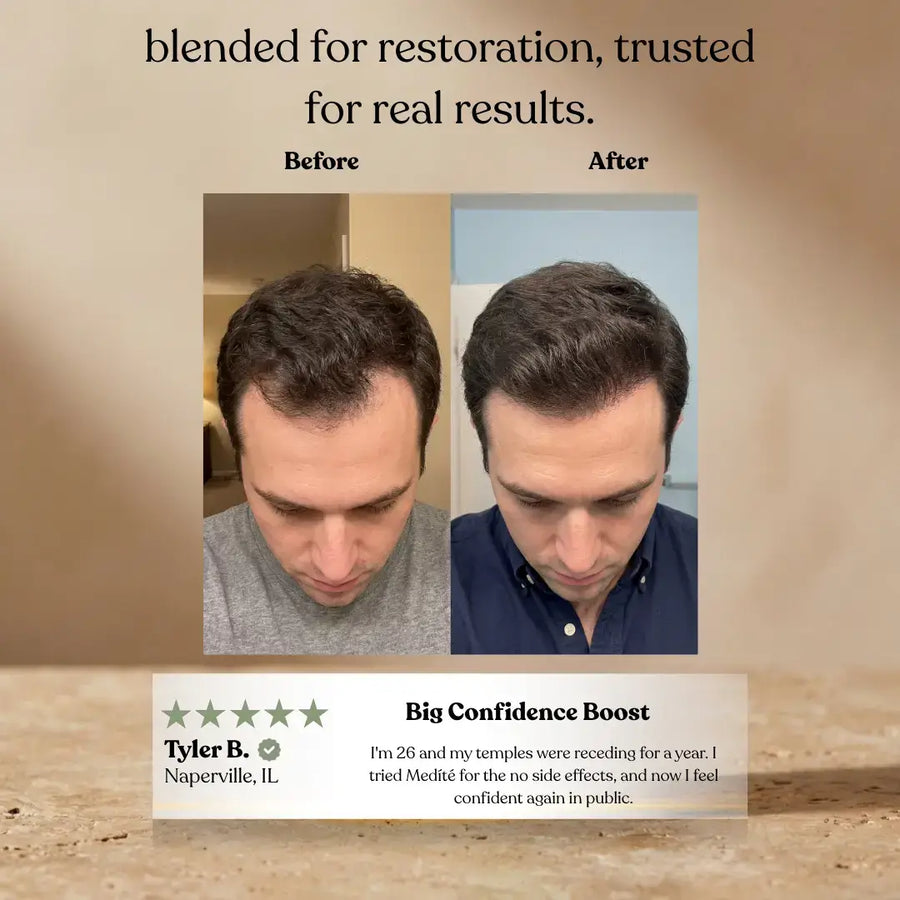 Men's hair regrowth before and after using Invictus rosemary oil, thicker fuller hair after 90 days