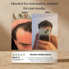 Before and after hair regrowth results from Invictus rosemary oil, receding hairline restored in 5 months