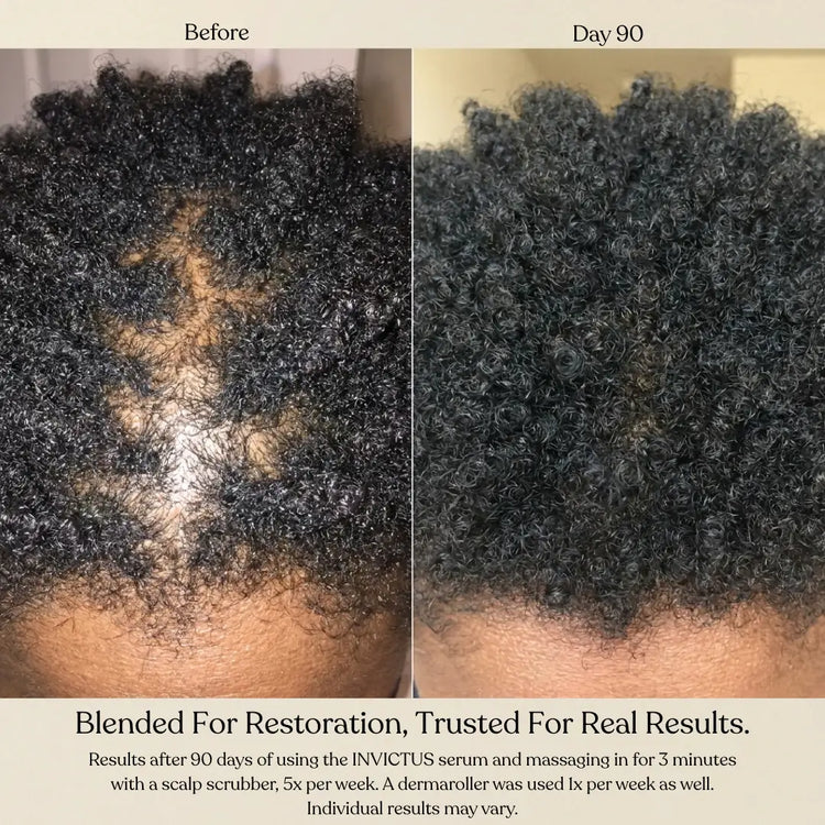 Before and Day 90 hair growth comparison showing dark curly hair on a scalp with visible thinning hair in the left panel and fuller hair in the right panel. Text at the bottom references Invictus serum and scalp massage results.