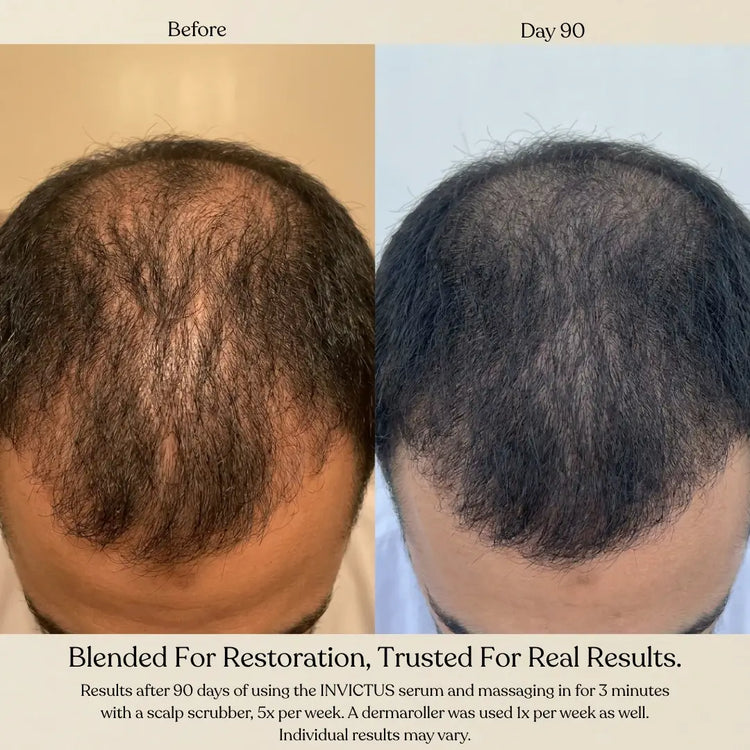 Before and day 90 comparison of a man's thinning hair on the crown of his head, showing hair growth results. Text at the bottom mentions Invictus serum and scalp massage.