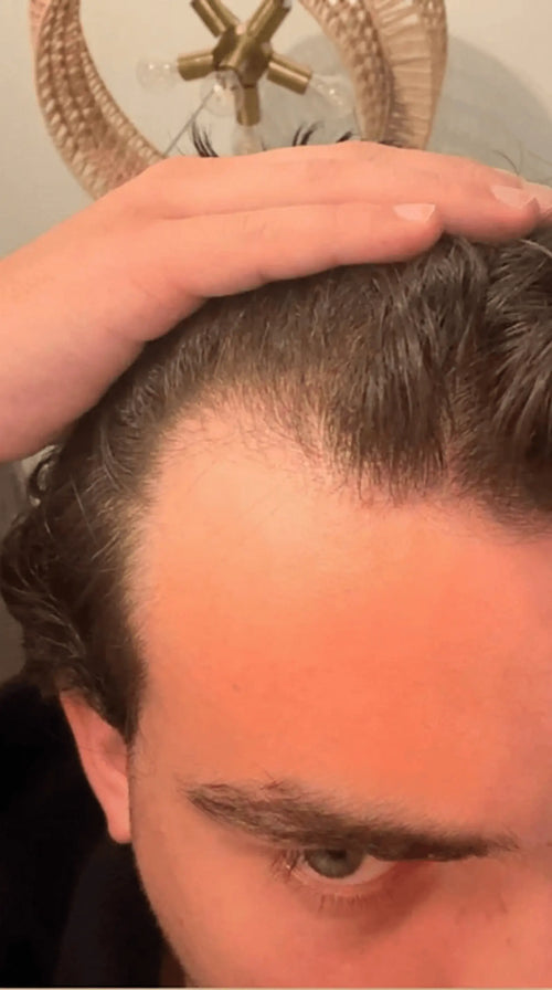 Before photo of a man with thinning hair on the crown and visible scalp before using Medité rosemary oil for hair growth