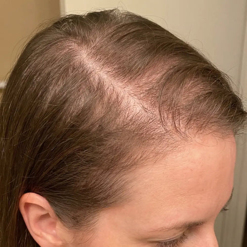 Before photo of thinning hair and visible scalp before consistent use of Medité plant-based hair growth oil for men and women